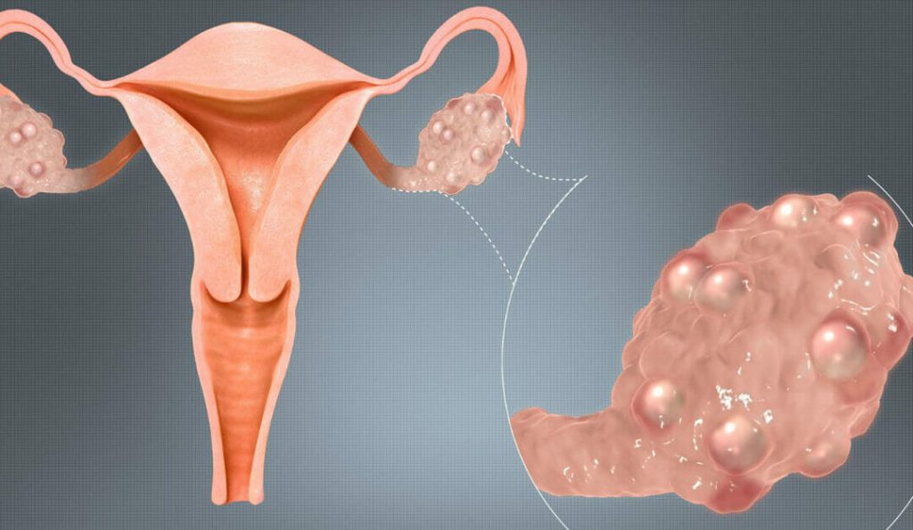 Πολυκυστικές ωοθήκες: Πώς να ενισχύσετε τη γονιμότητα για φυσική σύλληψη