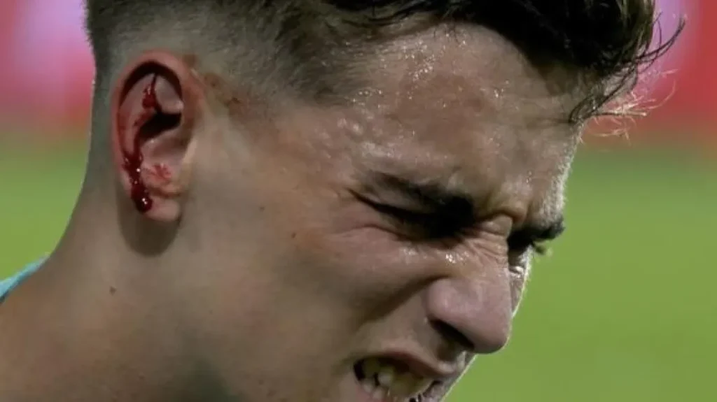 Γκάβι: Δείτε το τραυματισμένο αυτί του άσου της Μπαρτσελόνα – Σοκαριστική εικόνα