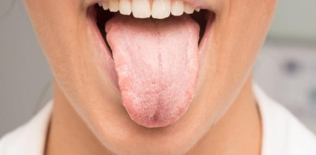 Μην τα αγνοήσετε: Τα σημάδια στη γλώσσα που «φανερώνουν» ότι υπάρχει πρόβλημα