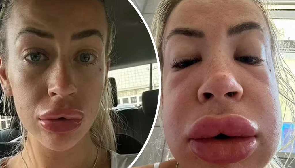 Πήγε να βγάλει το filler στα χείλη… και έγινε σαν ροφός: Η απίστευτη περιπέτεια μιας 27χρονης