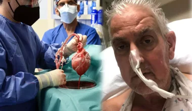 Μεταμόσχευση καρδιάς από χοίρο σε άνθρωπο: Πραγματοποιήθηκε ξανά – Ο πρώτος είχε πεθάνει δύο μήνες μετά την επέμβαση