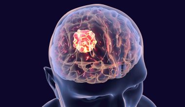 Όγκος στον εγκέφαλο: 10 συμπτώματα που μπορεί να οδηγήσουν σε λάθος διάγνωση