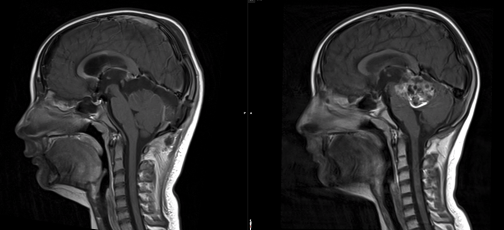 Ρωσία: 80χρονη ζει όλη της τη ζωή με μια βελόνα στον εγκέφαλο