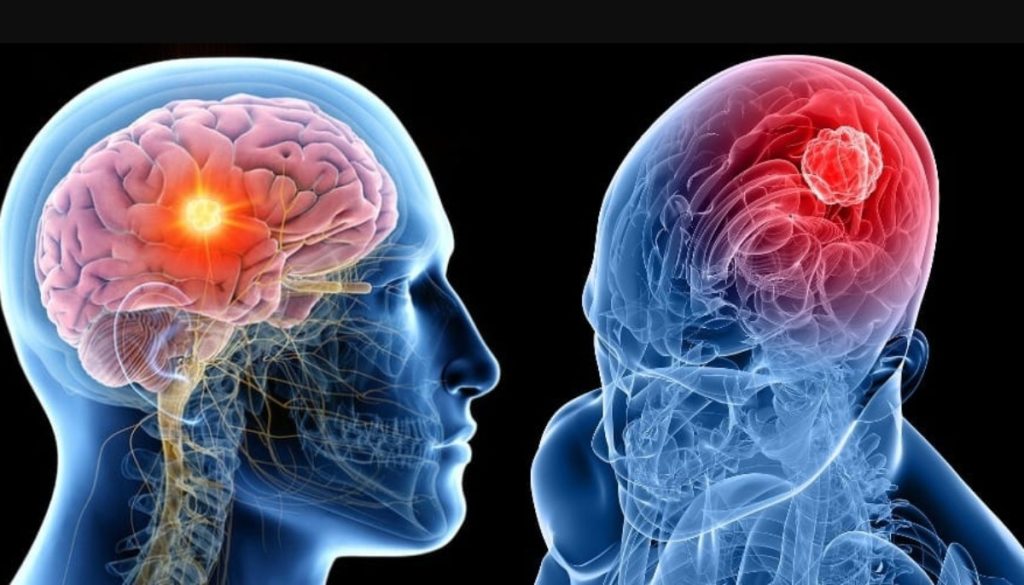 Καρκίνος στον εγκέφαλο: Αυτά είναι τα «αθώα» συμπτώματα που δεν πρέπει να αγνοήσετε