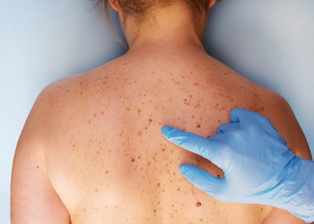 Προσοχή: Αυτός είναι ο πιο θανατηφόρος καρκίνος του δέρματος