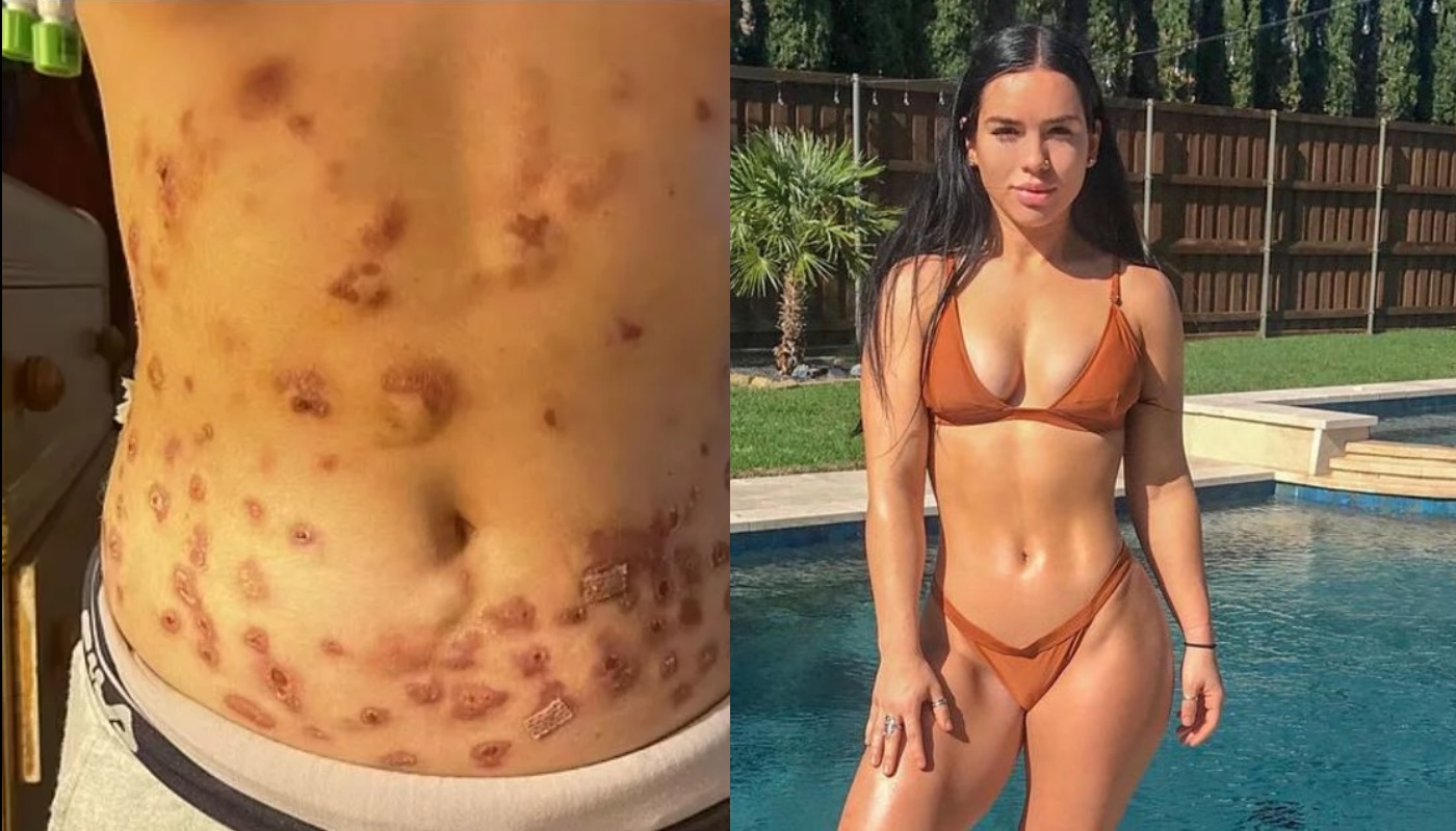 «Εφιάλτης» για fitness influencer: Έκανε «λιποδιαλυτικές» βιταμινούχες ενέσεις και άρχισε να σαπίζει το σώμα της (φώτο)