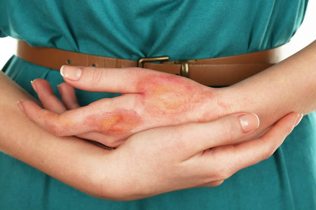 Νόσος Μορφέα: Όσα πρέπει να γνωρίζετε για την πάθηση που προκαλεί σκλήρυνση και αγγειακές μεταβολές στο δέρμα