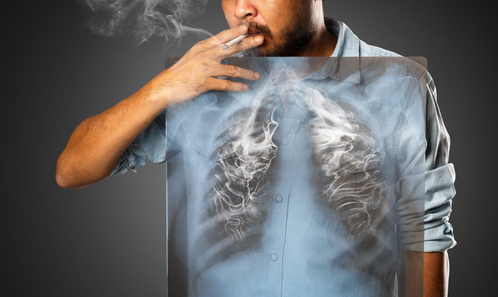 Έρευνα: Ποιοι καπνιστές πρέπει να κάνουν ετήσιο έλεγχο για καρκίνο του πνεύμονα