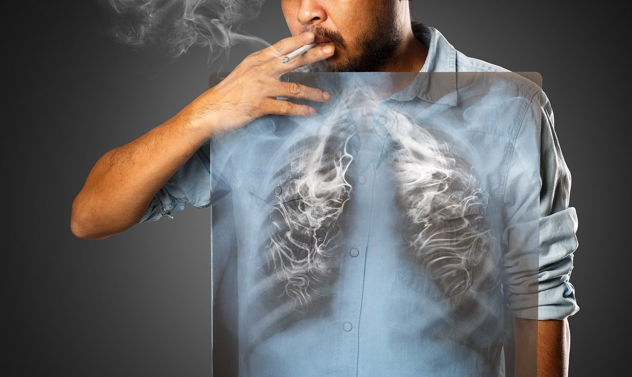 Έρευνα: Ποιοι καπνιστές πρέπει να κάνουν ετήσιο έλεγχο για καρκίνο του πνεύμονα