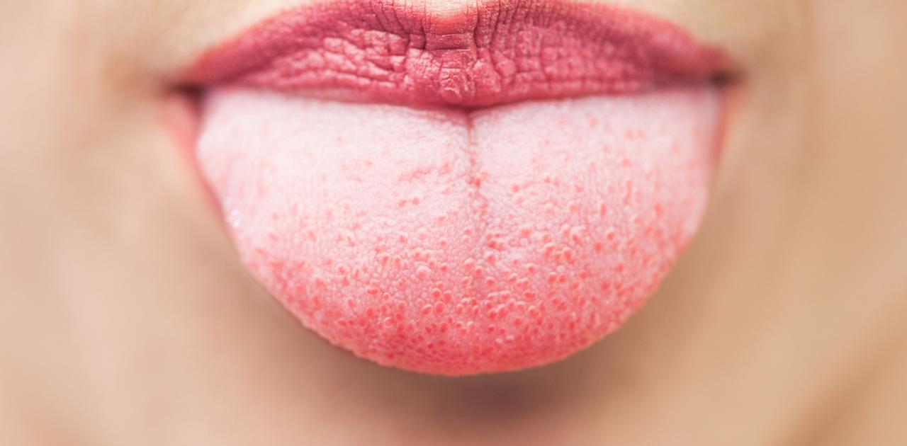 Έχετε αναρωτηθεί ποτέ; – Ποιες είναι οι αιτίες που προκαλούν… ρωγμές στη γλώσσα;