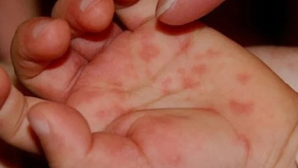 Ιός Κοξάκι: Αύξηση των κρουσμάτων στην Ελλάδα – Οι συστάσεις του ΕΟΔΥ