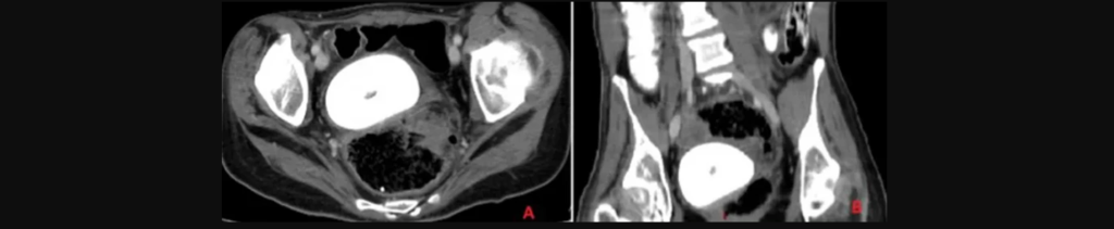 Λίβανος: Γιατροί αφαίρεσαν σπάνια «πέτρα του κόλπου» σε μέγεθος πορτοκαλιού (φωτο)