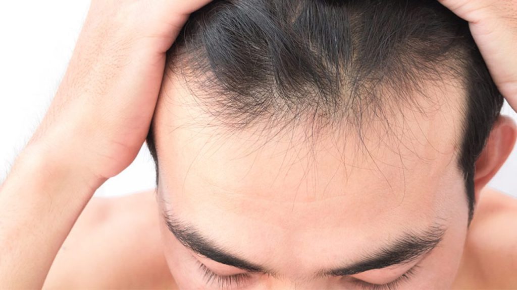 «Επιδημία» τριχόπτωσης στη Βόρεια Κορέα – Γιατί πολλοί χάνουν τα μαλλιά τους