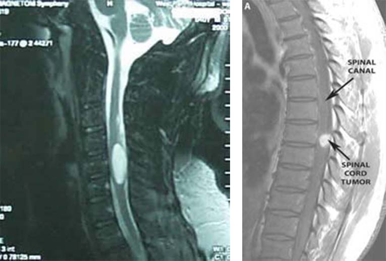 Όγκος στο νωτιαίο μυελό: Με ποια συμπτώματα εκδηλώνεται – Οι πιθανές θεραπείες