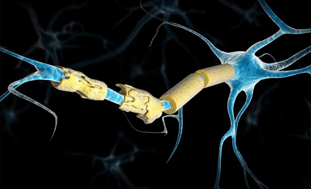 Σκλήρυνση κατά πλάκας: Τα συμπτώματα που μπορεί να προκαλέσει πέντε χρόνια πριν τη διάγνωση