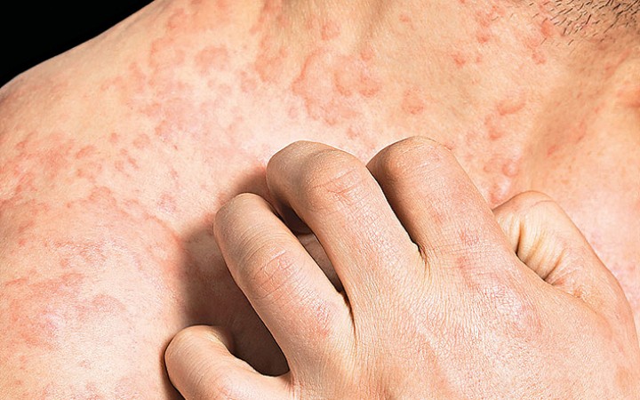 Αλλεργικό σοκ και αναφυλαξία: Σε τι διαφέρουν μεταξύ τους, ποια είναι τα πιθανά συμπτώματα και πώς αντιμετωπίζονται;