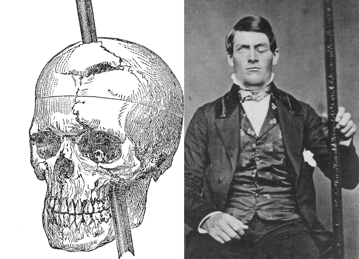 Η απίστευτη ιστορία του Phineas Gage: Του καρφώθηκε σιδερένια ράβδος στο κρανίο και επιβίωσε (βίντεο)
