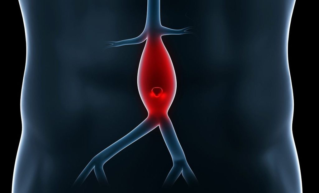 Νέα μελέτη: Η ασπιρίνη μπορεί να επιβραδύνει την εξέλιξη του ανευρύσματος κοιλιακής αορτής