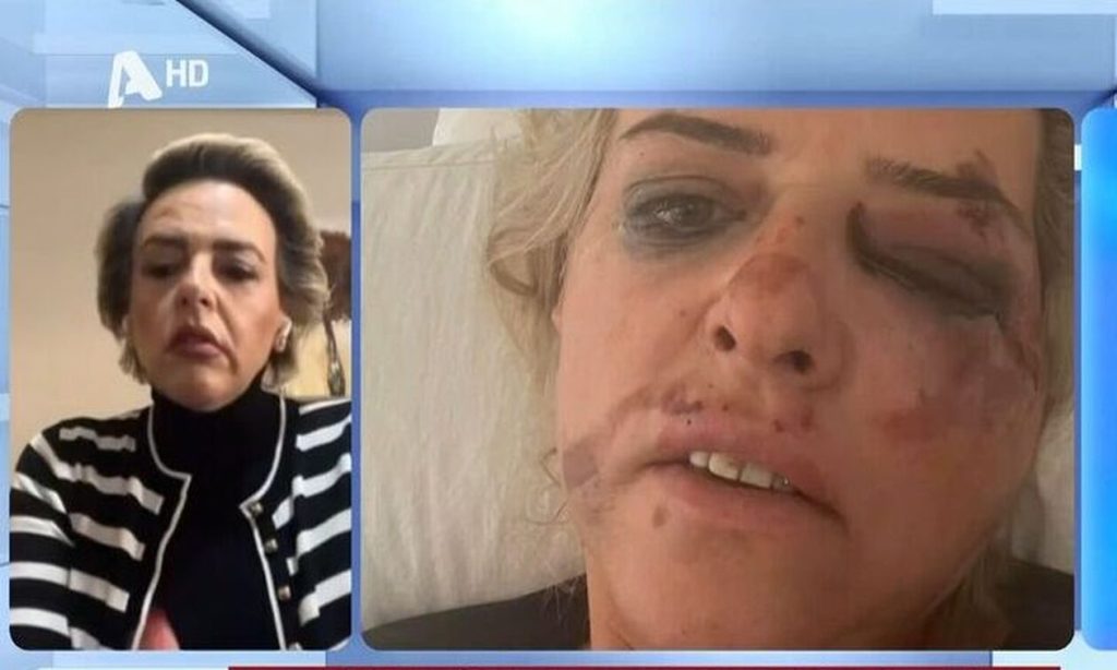 Καλαμάτα: «Θα μπορούσα να είμαι στη θέση της 50χρονης» λέει η γυναίκα που δέχθηκε επίθεση από αγέλη σκύλων 