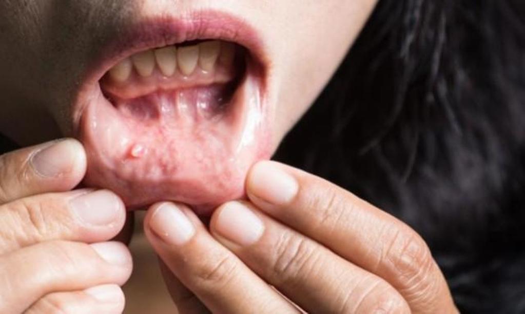 Καρκίνος στο στόμα: Αυτά είναι τα σημάδια που δεν πρέπει να αγνοήσετε