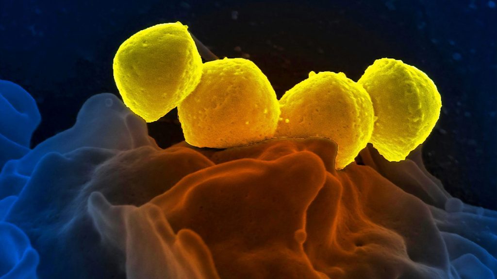 Σύνδρομο στρεπτοκοκκικού τοξικού σοκ: Τα συμπτώματα και ποιοι κινδυνεύουν περισσότερο – Τρόποι πρόληψης