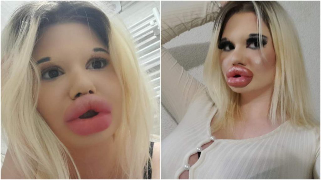 Βουλγαρία: Αυτή είναι η 26χρονη με τα μεγαλύτερα χείλη στον κόσμο – Δε σταματά τις πλαστικές (φωτο)