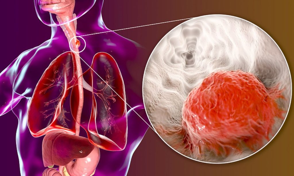 Τα υπερβολικά καυτά ροφήματα μπορούν να «εκτοξεύσουν» τις πιθανότητες εμφάνισης καρκίνου του οισοφάγου
