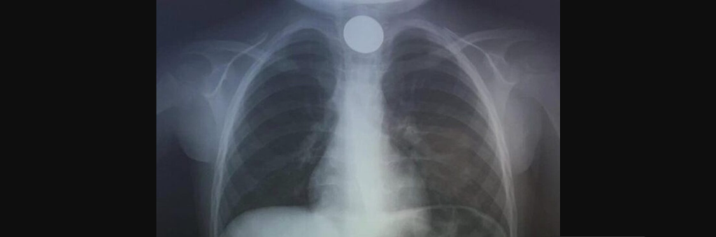 Κρήτη: Πρωτοχρονιάτικη περιπέτεια για 4χρονο που κατάπιε κέρμα