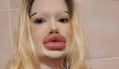 Βουλγαρία: Influencer έχει ξοδέψει πάνω από 20.000 ευρώ για να αποκτήσει τα μεγαλύτερα χείλη του κόσμου (φώτο-βίντεο)