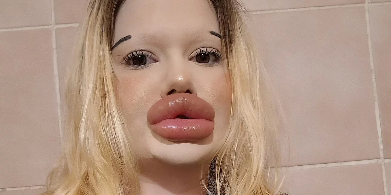 Βουλγαρία: Influencer έχει ξοδέψει πάνω από 20.000 ευρώ για να αποκτήσει τα μεγαλύτερα χείλη του κόσμου (φώτο-βίντεο)