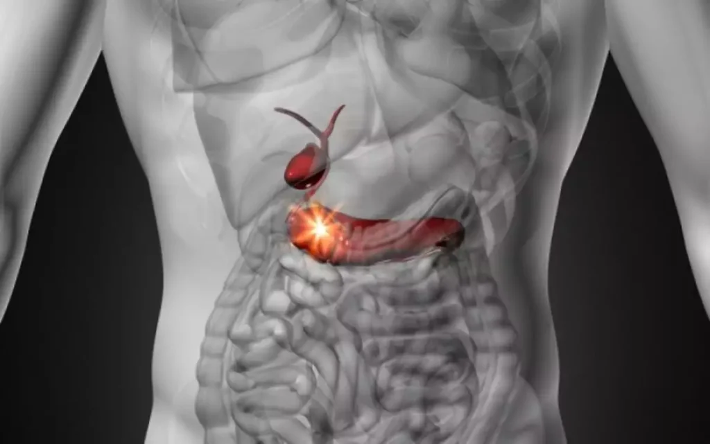 Καρκίνος παγκρέατος: Πόσο έχει αυξηθεί η πενταετής επιβίωση