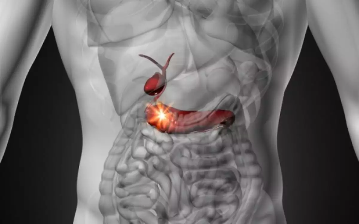 Καρκίνος παγκρέατος: Πόσο έχει αυξηθεί η πενταετής επιβίωση