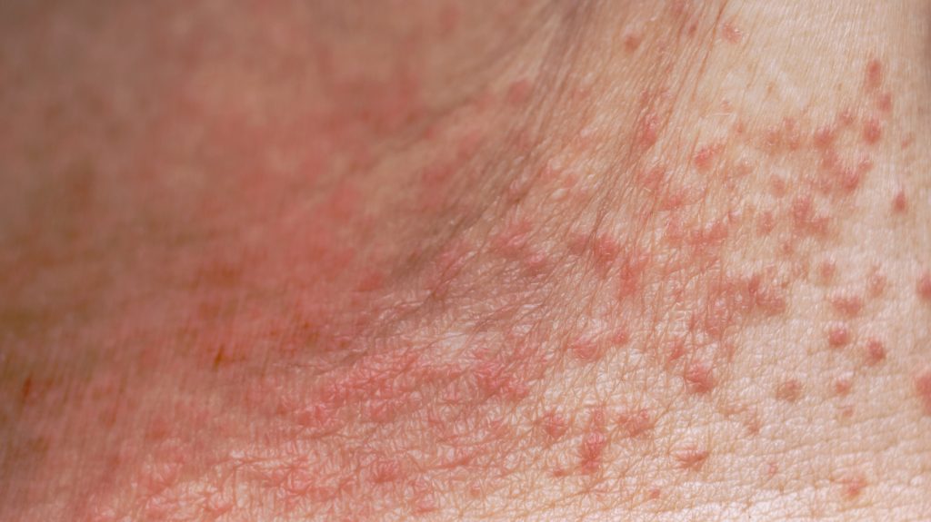 Αυστραλία: Η 11χρονη με την σπάνια πάθηση που είναι αλλεργική στον ιδρώτα της και στα δάκρυά της (φώτο)