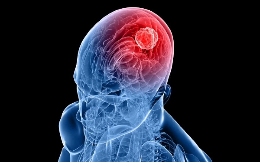 Καρκίνος του εγκεφάλου: Επιστήμονες ανέπτυξαν εξέταση αίματος που επιταχύνει τη διάγνωση και την έναρξη θεραπείας