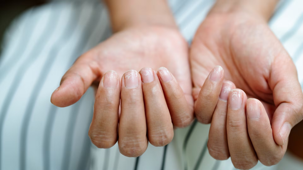 Όσα πρέπει να ξέρεις για τις λευκές κηλίδες στα νύχια – Πώς να απαλλαγείς