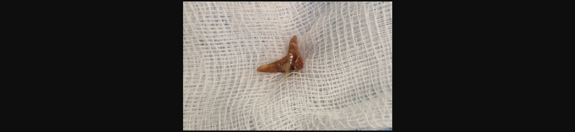 Κρήτη: Γυναίκα ζούσε για μήνες με ένα κόκκαλο από κουνέλι στον πνεύμονα της