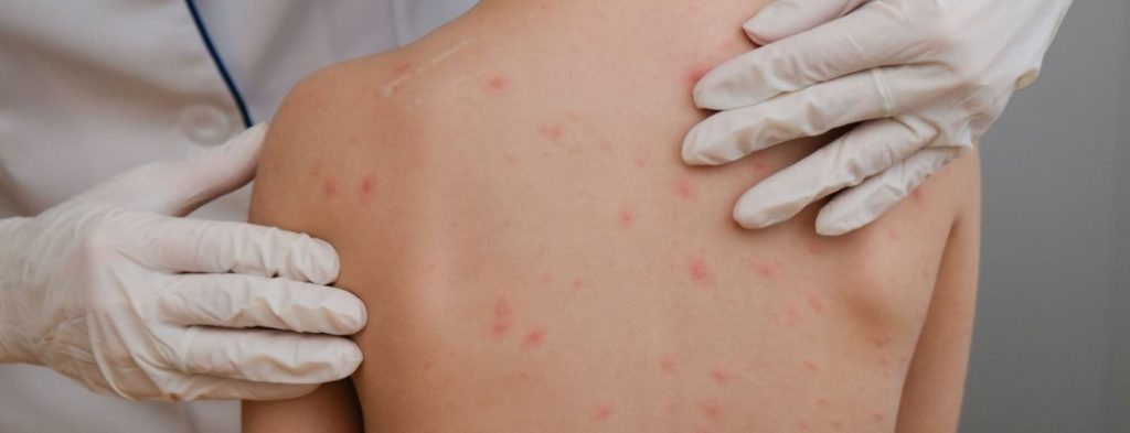 ΕΟΔΥ: Συστήνεται ομάδα εργασίας για την αντιμετώπιση πιθανής έξαρσης της ιλαράς – Τα συμπτώματα και η θεραπεία