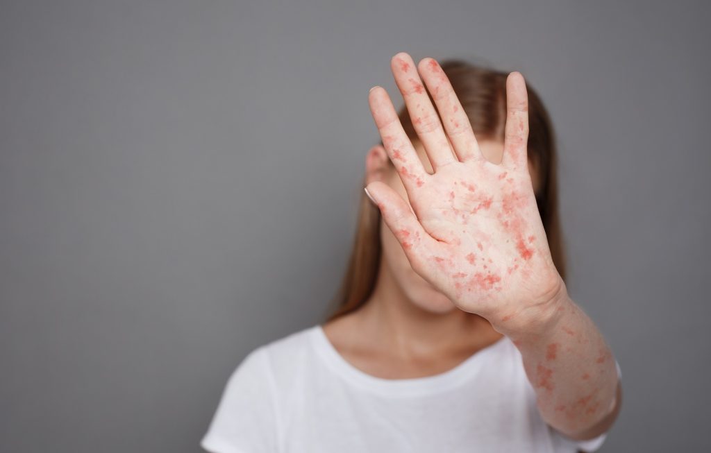 Ιλαρά: Δείτε ποια είναι τα συμπτώματα και οι πιθανές επιπλοκές