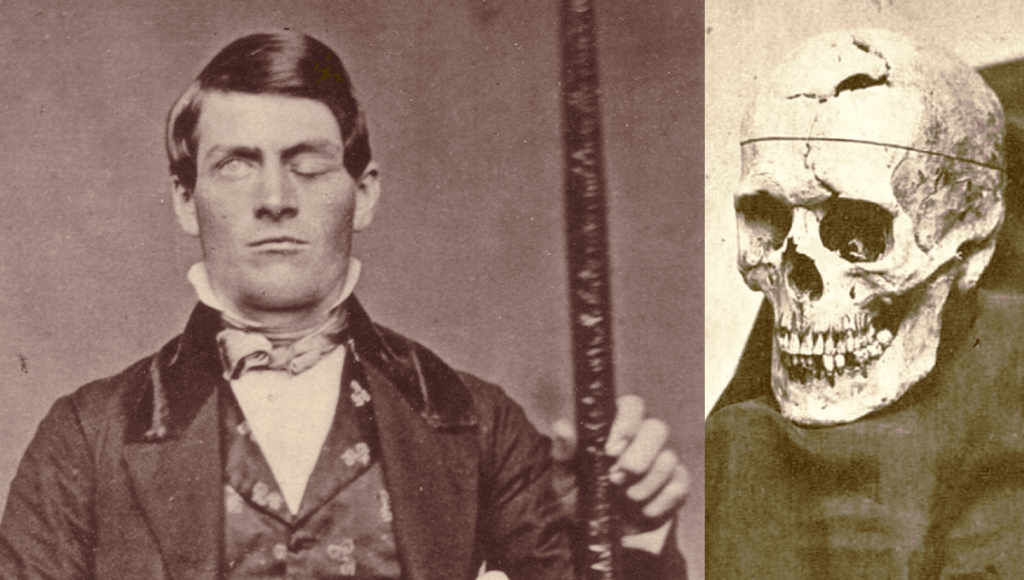 Η απίστευτη ιστορία του Phineas Gage: Του καρφώθηκε σιδερένια ράβδος στο κρανίο και επιβίωσε (βίντεο)