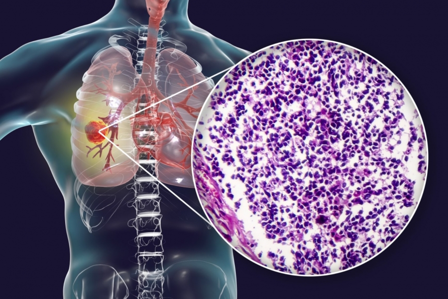 Καρκίνος του πνεύμονα: Εγκρίθηκε θεραπεία με συνδυασμό αντικαρκινικού φαρμάκου και χημειοθεραπείας