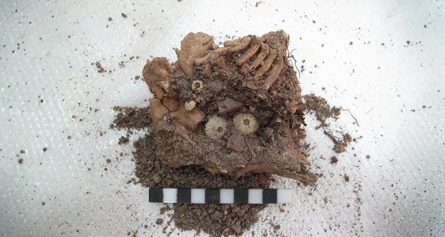 Έρευνα σε σκελετό παιδιού εντόπισε την πρώτη γνωστή περίπτωση συνδρόμου Down κατά την αρχαιότητα στην Ελλάδα