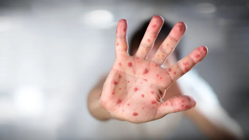 Τα έξι έφτασαν τα κρούσματα ιλαράς στην Ελλάδα – Σε ποιες περιοχές έχουν εμφανιστεί