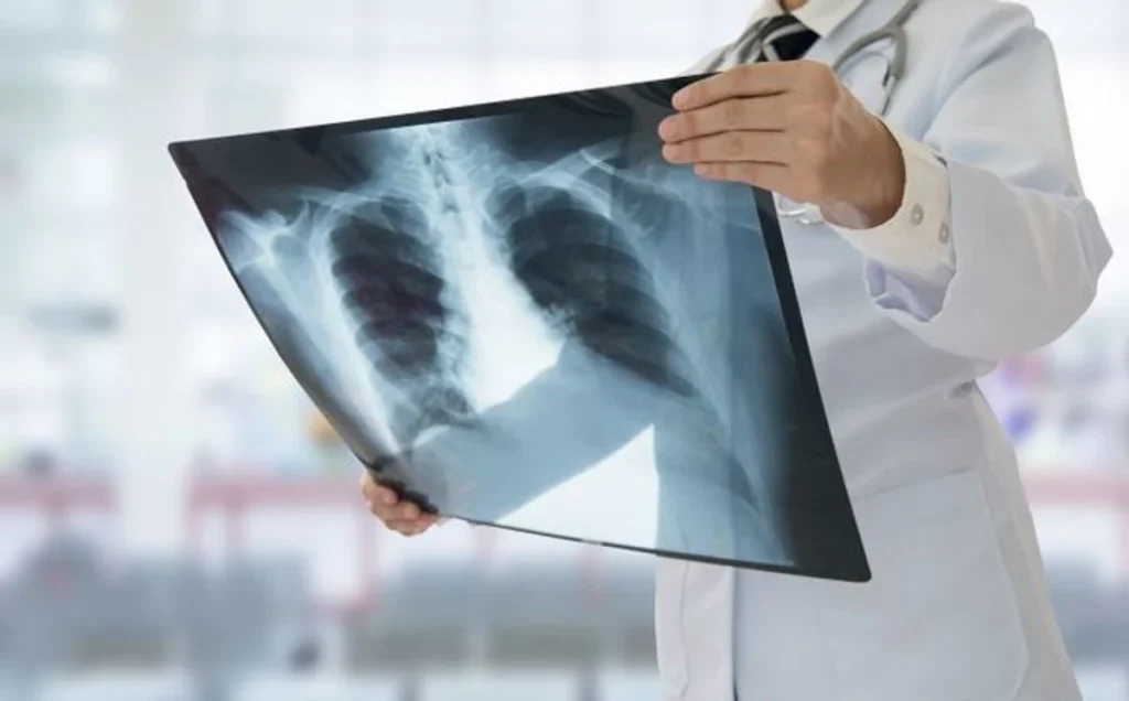 Πνευμονικοί όζοι: Δείτε ποια είναι τα συμπτώματα και ποιοι κινδυνεύουν περισσότερο