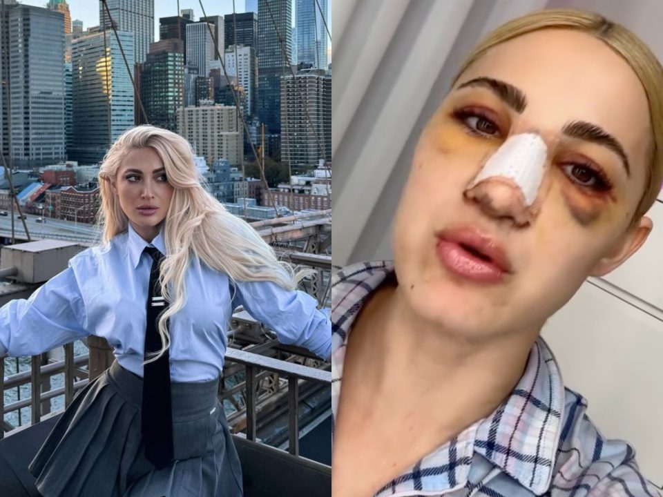 Ι.Τούνη: «Είμαι πάρα πολύ πρησμένη – Πήρα χόνδρο από το πλευρό μου για να φτιάξω τη μύτη μου»