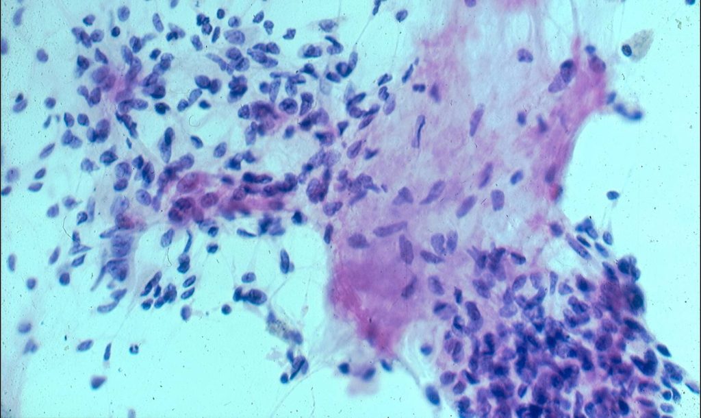 Τι είναι το αμάρτωμα; – Τα συμπτώματα και σε ποια σημεία μπορεί να εκδηλωθεί