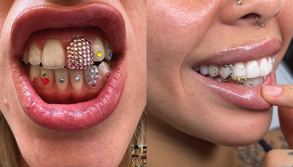Νέα… τάση στη Βρετανία: Στολίζουν τα δόντια τους με Swarovski, πολύτιμους λίθους και μέταλλα (φώτο)