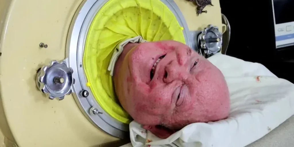 Τέξας: Πέθανε ο άνδρας που ζούσε σε σιδερένιο πνεύμονα εδώ και 70 χρόνια – Προσβλήθηκε από πολιομυελίτιδα σε ηλικία 6 ετών 