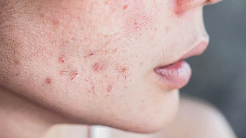 Ακμή και ουλές: Τα διαφορετικά είδη και ποιοι κινδυνεύουν περισσότερο να τις εκδηλώσουν