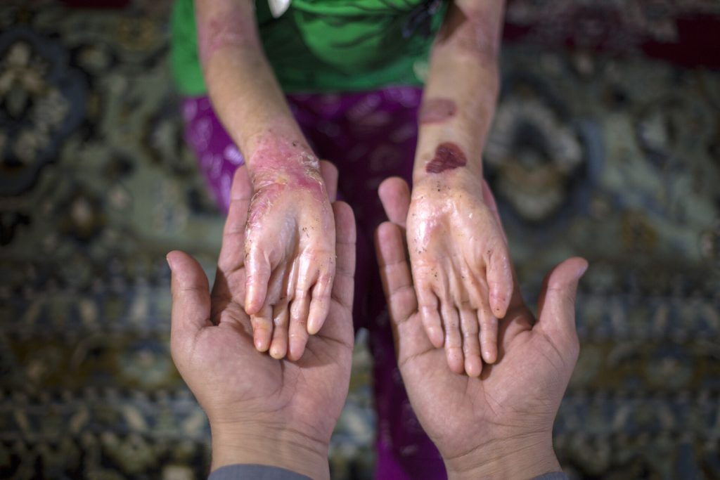 Πομφολυγώδης Επιδερμόλυση: Η σπάνια γενετική νόσος που οδηγεί σε μια επώδυνη καθημερινότητα