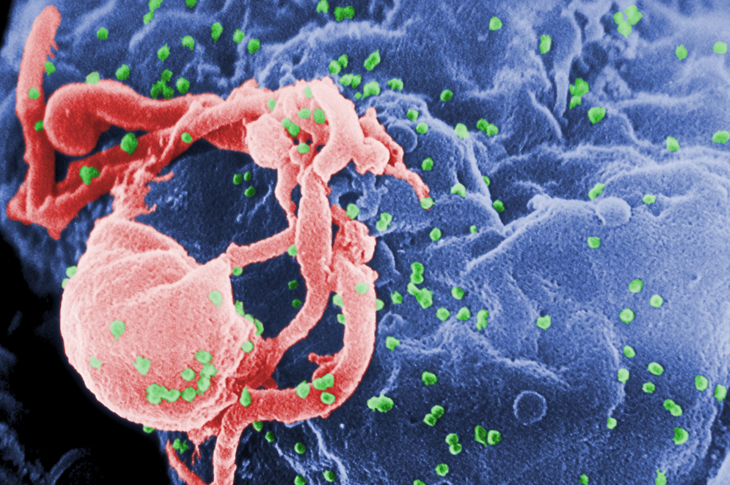 Ολλανδία: Επιστήμονες κατάφεραν να εξαλείψουν τον ιό HIV από μολυσμένα κύτταρα – Ποια μέθοδο χρησιμοποίησαν